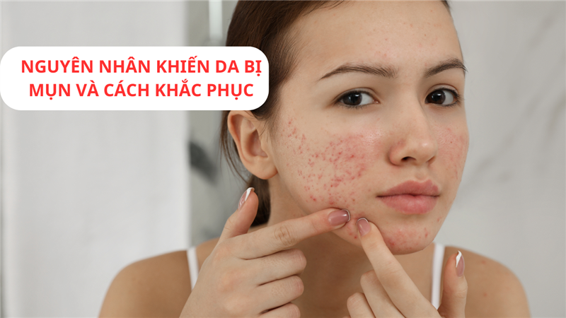 NGUYÊN NHÂN KHIẾN DA BỊ MỤN VÀ CÁCH KHẮC PHỤC
